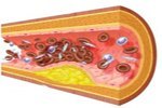 Arteria afectada por una placa de materia grasa que obstruye el flujo sanguíneo