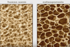 Diferencia entre un hueso sano y un hueso con osteoporosis
